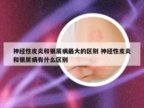 神经性皮炎和银屑病最大的区别 神经性皮炎和银屑病有什么区别