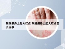 银屑病身上起大红点 银屑病身上起大红点怎么回事