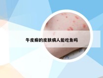 牛皮癣的皮肤病人能吃鱼吗