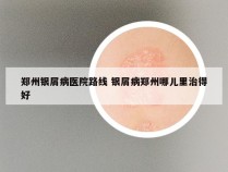 郑州银屑病医院路线 银屑病郑州哪儿里治得好