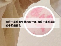 治疗牛皮癣的中草药有什么 治疗牛皮癣最好的中药是什么
