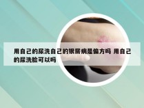用自己的尿洗自己的银屑病是偏方吗 用自己的尿洗脸可以吗