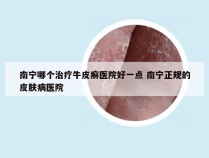 南宁哪个治疗牛皮癣医院好一点 南宁正规的皮肤病医院
