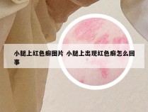 小腿上红色癣图片 小腿上出现红色癣怎么回事
