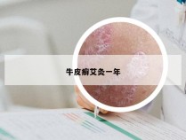 牛皮癣艾灸一年