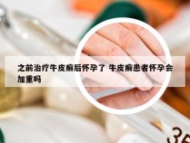 之前治疗牛皮癣后怀孕了 牛皮癣患者怀孕会加重吗