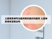 儿童银屑病专治医院哪家最好的医院 儿童银屑病有望根治吗