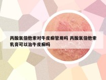 丙酸氯倍他索对牛皮癣管用吗 丙酸氯倍他索乳膏可以治牛皮癣吗