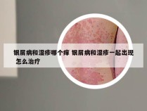银屑病和湿疹哪个痒 银屑病和湿疹一起出现 怎么治疗