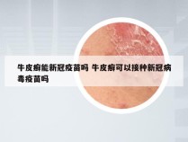 牛皮癣能新冠疫苗吗 牛皮癣可以接种新冠病毒疫苗吗