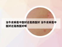 治牛皮癣是中医好还是西医好 治牛皮癣是中医好还是西医好呢