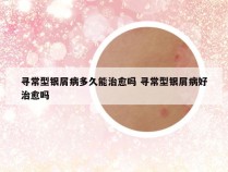 寻常型银屑病多久能治愈吗 寻常型银屑病好治愈吗