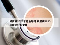 银屑病2023年能治好吗 银屑病2023年能治好吗女性