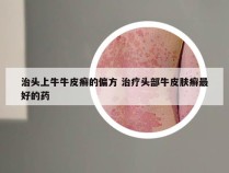 治头上牛牛皮癣的偏方 治疗头部牛皮肤癣最好的药
