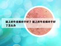 腿上的牛皮癣终于好了 腿上的牛皮癣终于好了怎么办