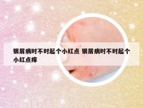 银屑病时不时起个小红点 银屑病时不时起个小红点痒