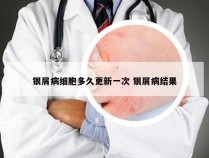银屑病细胞多久更新一次 银屑病结果