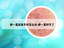 癣一直反复不好怎么办 癣一直好不了