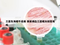 三亚东海晒牛皮癣 银屑病在三亚晒太阳管用吗