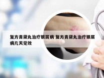 复方青黛丸治疗银屑病 复方青黛丸治疗银屑病几天见效