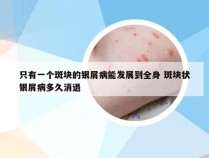 只有一个斑块的银屑病能发展到全身 斑块状银屑病多久消退