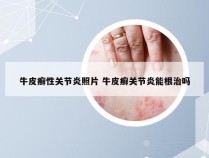 牛皮癣性关节炎照片 牛皮癣关节炎能根治吗