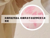 白癞风能传染么 白癞风会不会遗传吗多久会发现