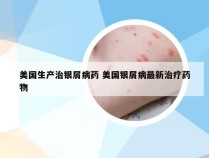 美国生产治银屑病药 美国银屑病最新治疗药物