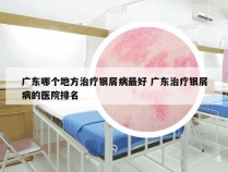 广东哪个地方治疗银屑病最好 广东治疗银屑病的医院排名