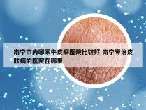南宁市内哪家牛皮癣医院比较好 南宁专治皮肤病的医院在哪里