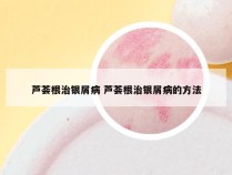 芦荟根治银屑病 芦荟根治银屑病的方法
