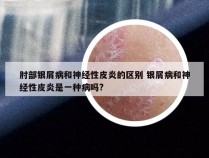 肘部银屑病和神经性皮炎的区别 银屑病和神经性皮炎是一种病吗?
