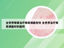 全世界哪里治疗银屑病最有效 全世界治疗银屑病最好的医院