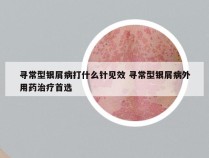 寻常型银屑病打什么针见效 寻常型银屑病外用药治疗首选