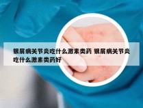 银屑病关节炎吃什么激素类药 银屑病关节炎吃什么激素类药好