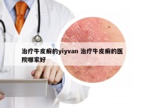 治疗牛皮癣的yiyvan 治疗牛皮癣的医院哪家好