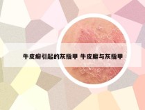 牛皮癣引起的灰指甲 牛皮廨与灰指甲