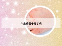 牛皮癣是中毒了吗
