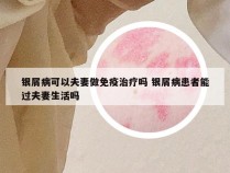 银屑病可以夫妻做免疫治疗吗 银屑病患者能过夫妻生活吗