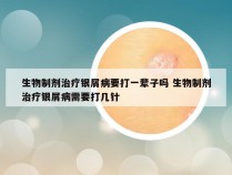 生物制剂治疗银屑病要打一辈子吗 生物制剂治疗银屑病需要打几针
