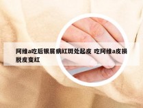 阿维a吃后银屑病红斑处起皮 吃阿维a皮损脱皮变红