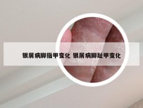银屑病脚指甲变化 银屑病脚趾甲变化
