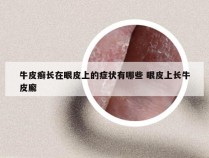 牛皮癣长在眼皮上的症状有哪些 眼皮上长牛皮廨