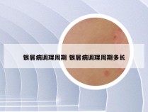 银屑病调理周期 银屑病调理周期多长