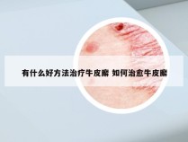 有什么好方法治疗牛皮廨 如何治愈牛皮廨