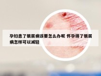 孕妇患了银屑病该要怎么办呢 怀孕得了银屑病怎样可以减轻