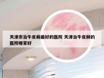 天津市治牛皮癣最好的医院 天津治牛皮鲜的医院哪家好