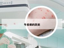 牛皮癣的历史