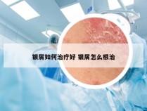 银屑如何治疗好 银屑怎么根治