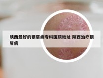 陕西最好的银屑病专科医院地址 陕西治疗银屑病